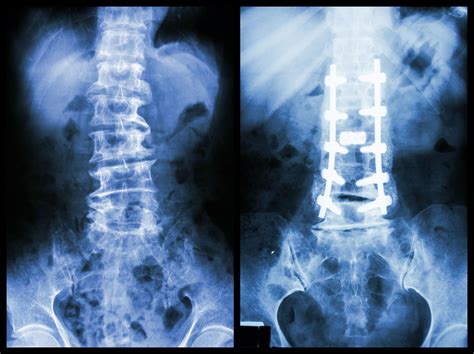 metal brackets pulled from spine|why does my spine hardware break.